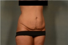 Tummy Tuck Before Photo by Ellen Janetzke, MD; Bloomfield Hills, MI - Case 46515