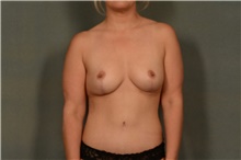 Breast Lift After Photo by Ellen Janetzke, MD; Bloomfield Hills, MI - Case 46516