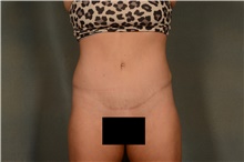 Tummy Tuck After Photo by Ellen Janetzke, MD; Bloomfield Hills, MI - Case 46517