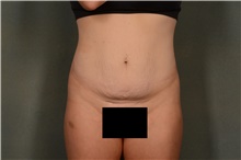 Tummy Tuck Before Photo by Ellen Janetzke, MD; Bloomfield Hills, MI - Case 46517