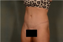 Tummy Tuck After Photo by Ellen Janetzke, MD; Bloomfield Hills, MI - Case 46517
