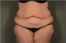 Tummy Tuck Before Photo by Ellen Janetzke, MD; Bloomfield Hills, MI - Case 46729