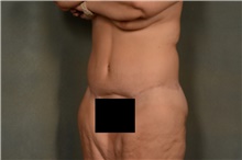 Tummy Tuck After Photo by Ellen Janetzke, MD; Bloomfield Hills, MI - Case 46729