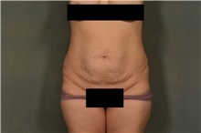 Tummy Tuck Before Photo by Ellen Janetzke, MD; Bloomfield Hills, MI - Case 46730