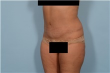 Tummy Tuck After Photo by Ellen Janetzke, MD; Bloomfield Hills, MI - Case 46730