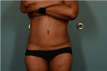 Tummy Tuck After Photo by Ellen Janetzke, MD; Bloomfield Hills, MI - Case 47119