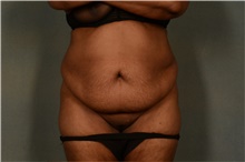 Tummy Tuck Before Photo by Ellen Janetzke, MD; Bloomfield Hills, MI - Case 47119