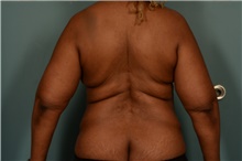 Liposuction After Photo by Ellen Janetzke, MD; Bloomfield Hills, MI - Case 47120