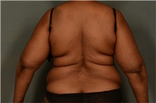 Liposuction Before Photo by Ellen Janetzke, MD; Bloomfield Hills, MI - Case 47120