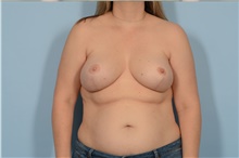 Breast Augmentation After Photo by Ellen Janetzke, MD; Bloomfield Hills, MI - Case 47121