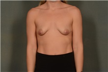 Breast Augmentation Before Photo by Ellen Janetzke, MD; Bloomfield Hills, MI - Case 47122