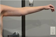 Arm Lift After Photo by Ellen Janetzke, MD; Bloomfield Hills, MI - Case 47123