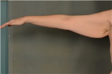 Arm Lift Before Photo by Ellen Janetzke, MD; Bloomfield Hills, MI - Case 47123
