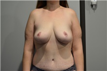 Breast Lift After Photo by Ellen Janetzke, MD; Bloomfield Hills, MI - Case 47124