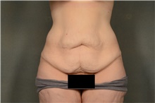 Tummy Tuck Before Photo by Ellen Janetzke, MD; Bloomfield Hills, MI - Case 47125