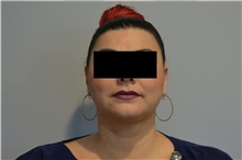 Liposuction After Photo by Ellen Janetzke, MD; Bloomfield Hills, MI - Case 47126