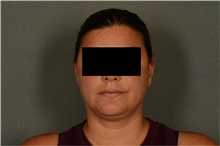 Liposuction Before Photo by Ellen Janetzke, MD; Bloomfield Hills, MI - Case 47126