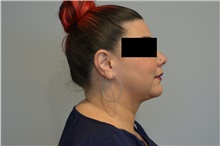 Liposuction After Photo by Ellen Janetzke, MD; Bloomfield Hills, MI - Case 47126