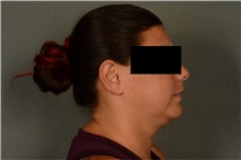 Liposuction Before Photo by Ellen Janetzke, MD; Bloomfield Hills, MI - Case 47126