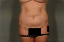 Liposuction Before Photo by Ellen Janetzke, MD; Bloomfield Hills, MI - Case 47127