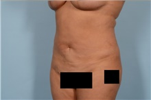 Liposuction After Photo by Ellen Janetzke, MD; Bloomfield Hills, MI - Case 47127