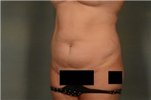 Liposuction Before Photo by Ellen Janetzke, MD; Bloomfield Hills, MI - Case 47127