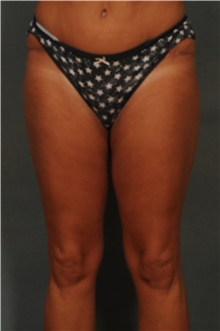 Liposuction After Photo by Ellen Janetzke, MD; Bloomfield Hills, MI - Case 47211