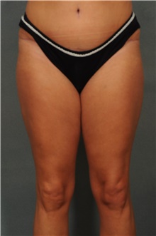 Liposuction Before Photo by Ellen Janetzke, MD; Bloomfield Hills, MI - Case 47211