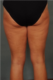 Liposuction Before Photo by Ellen Janetzke, MD; Bloomfield Hills, MI - Case 47211