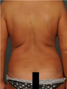 Liposuction After Photo by Ellen Janetzke, MD; Bloomfield Hills, MI - Case 47212