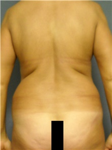 Liposuction Before Photo by Ellen Janetzke, MD; Bloomfield Hills, MI - Case 47212