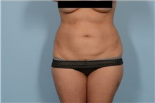 Liposuction After Photo by Ellen Janetzke, MD; Bloomfield Hills, MI - Case 47213