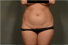 Liposuction Before Photo by Ellen Janetzke, MD; Bloomfield Hills, MI - Case 47213
