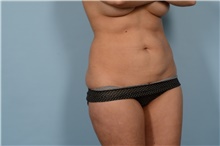 Liposuction After Photo by Ellen Janetzke, MD; Bloomfield Hills, MI - Case 47213