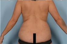 Liposuction After Photo by Ellen Janetzke, MD; Bloomfield Hills, MI - Case 47214