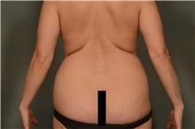 Liposuction Before Photo by Ellen Janetzke, MD; Bloomfield Hills, MI - Case 47214