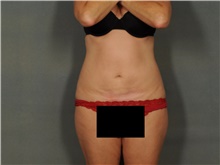 Liposuction After Photo by Ellen Janetzke, MD; Bloomfield Hills, MI - Case 47215