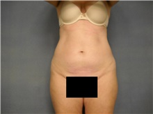 Liposuction Before Photo by Ellen Janetzke, MD; Bloomfield Hills, MI - Case 47215