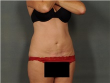Liposuction After Photo by Ellen Janetzke, MD; Bloomfield Hills, MI - Case 47215