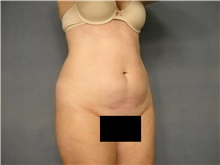 Liposuction Before Photo by Ellen Janetzke, MD; Bloomfield Hills, MI - Case 47215