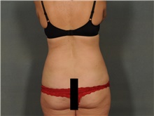 Liposuction After Photo by Ellen Janetzke, MD; Bloomfield Hills, MI - Case 47216