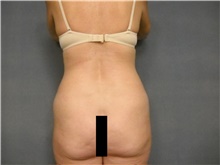 Liposuction Before Photo by Ellen Janetzke, MD; Bloomfield Hills, MI - Case 47216