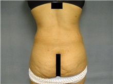 Liposuction After Photo by Ellen Janetzke, MD; Bloomfield Hills, MI - Case 47217