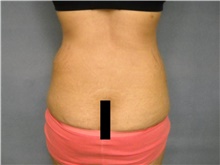 Liposuction Before Photo by Ellen Janetzke, MD; Bloomfield Hills, MI - Case 47217