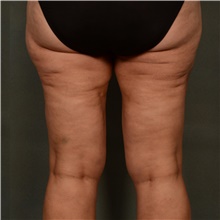 Liposuction After Photo by Ellen Janetzke, MD; Bloomfield Hills, MI - Case 47218