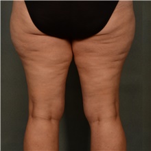 Liposuction Before Photo by Ellen Janetzke, MD; Bloomfield Hills, MI - Case 47218