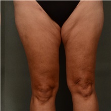Liposuction After Photo by Ellen Janetzke, MD; Bloomfield Hills, MI - Case 47218