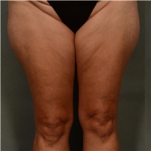 Liposuction Before Photo by Ellen Janetzke, MD; Bloomfield Hills, MI - Case 47218