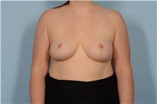 Breast Reduction After Photo by Ellen Janetzke, MD; Bloomfield Hills, MI - Case 47579