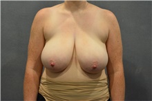 Breast Reduction Before Photo by Ellen Janetzke, MD; Bloomfield Hills, MI - Case 47579